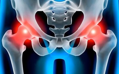 Artrosis de cadera y envejecimiento